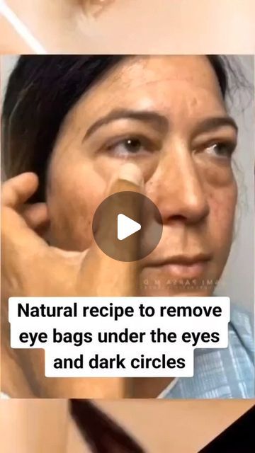 HealthTipssssss on Instagram: "NATURAL RECIPE TO REMOVE EYE BAGS UNDER remove

THE EYES AND DARK CIRCLES

Leve bags under the eyes

#darkcircles

#skin#naturalremedy circles

#womenshealth

#healthy#uganda#southafrica

#worldwide #naturalremedies" Undereye Bags Remedy, Eye Bag Remedies, Eye Health Remedies, Puffy Eyes Remedy, Dark Circles Makeup, Remove Eye Bags, Dark Eye Circles, Brown Spots Removal, Under Eye Puffiness