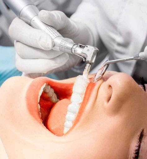 What is Laser Teeth BleachingThe biggest advantage of laser teeth bleaching is that the procedure can be performed in a very short timeIt is a bleaching process performed in a short period of approximately 4 minutes after isolating all soft tissues with a barrier. Teeth Bleaching, Tooth Removal, Emergency Dentist, Tooth Extraction, Dental Cleaning, Dental Teeth, Dental Problems, Natural Teeth, Healthy Teeth