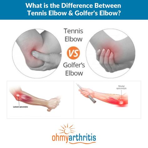 Even if you’ve never played a set of tennis or a round of golf, you can still suffer from Tennis Elbow or Golfer’s Elbow. Tennis Elbow and Golfer’s Elbow are both overuse injuries that are caused activities that requires repetitive motion of the arm and wrist. The difference between the two conditions lies in where the elbow is inflamed. Learn the causes, symptoms and helpful tips for treating them both: Tennis Elbow Vs Golfers Elbow, Golfers Elbow, Kt Tape, Elbow Braces, Sciatica Exercises, Tennis Elbow, What Is The Difference Between, Play Tennis, Sciatica