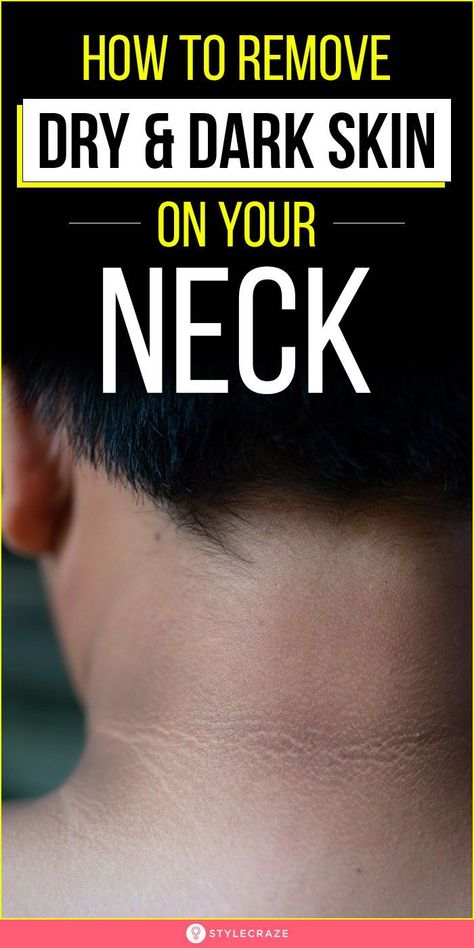 Diy Dark Spot Remover Under Arms, How To Remove Dark Spots On Neck, Neck Discoloration Remedies, How To Whiten Neck, How To Remove Dark Neck Remedies, Clean Neck Skin, How To Clean Dark Neck, Hyperpigmentation On Neck, Dark Skin Removal