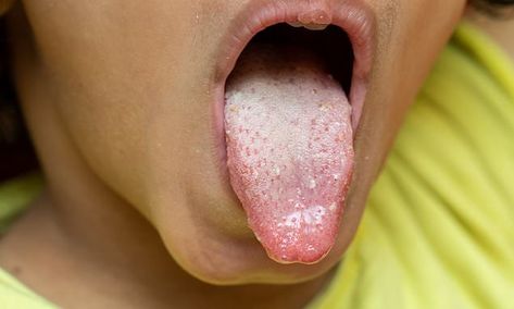 Dr Martin Scurr: What's the cause of my sore, cracked tongue?  | Daily Mail Online Cracked Tongue, Sore Tongue, Tongue Sores, Hot Food, Folic Acid, Doctor Medical, Citrus Fruit, Mouthwash, Medical Care