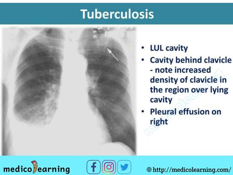 Chest X-ray interpretation Respiratory Therapy Notes, Chest Xray, Medical Radiography, Radiology Student, Medical Ultrasound, Medical Mnemonics, Radiology Imaging, Radiology Tech, Radiology Technologist