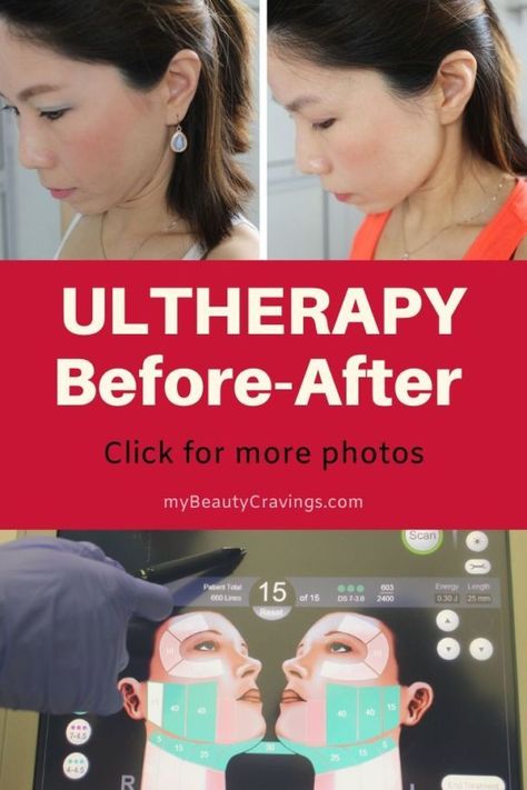 Ultherapy Results (Lower Face): Before & After Photos show slimmer face, sharper under-chin and taut skin. Click to view more before-after photos. #ultherapy #ultera #antiaging #antiageing #beautyreview #antiwrinkles #hifu #ultrasound #beforeandafter Ultherapy Before And After, Beauty Basket, Face Pores, Extra Skin, Aging Beauty, Smaller Pores, Laser Clinics, Excess Skin, Slimmer Face