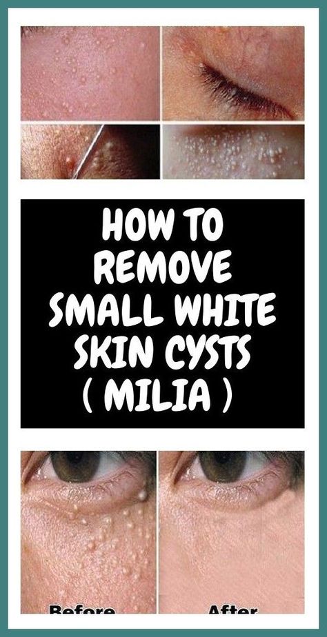 #cyst #fibroid #senggugut #pimple #acne #pimplepopping #blackhead #blackheads #pimplepopper #pimples White Skin, Health Advice, Health And Fitness Tips, Wellness Tips, Healthy Tips, Blackheads, Back Pain, Beauty Health, Fitness Tips