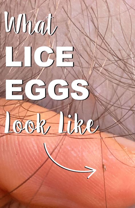 One of the most misunderstood things about lice is what lice eggs and nits look like. With misinformation and myths flooding the internet about lice eggs, it’s easy to understand why folks are confused.  As a lice professional, I use nine simple tricks to spot and identify lice eggs (also known as “nits”) within seconds. Read the article "What Lice Eggs and Nits Look Like: Pictures of Lice Eggs in Hair" to learn the 9 simple tricks to identify lice like a pro. #Lice #nits #liceinhair #superlice Eggs In Hair, Lice Nits, Lice Remedies, Lice Eggs, Egg For Hair, Lice Removal, Doterra Essential Oils Recipes, Head Louse, Fat Burning Diet