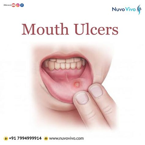 Mouth ulcers (Canker sores) are those painful lesions that occur on the gum, inside of the lips and other areas of the mouth. While most of these sores go away in a week or two, they can make drinking, eating, etc quite uncomfortable. Gum Pain Relief Remedies, Home Gum, Mouth Ulcer, Lifestyle Diseases, Bad Breath Remedy, Mineral Deficiency, Pain Relief Remedies, Canker Sore, Irritable Bowel