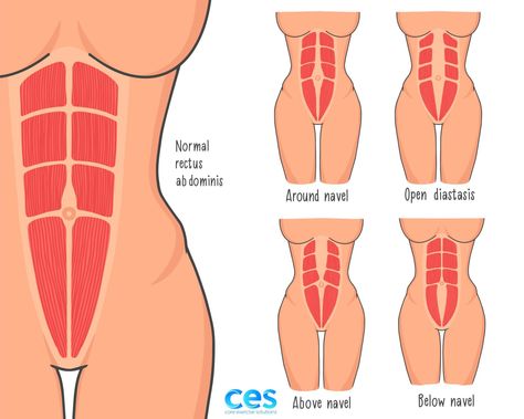 Diastasis [Converted] Stomach Pooch, Flabby Stomach, Pelvic Pain Relief, What Is Diastasis Recti, Rectus Abdominis Muscle, Pilates Teacher Training, Lower Belly Pooch, Pregnancy Safe Workouts, Mummy Tummy