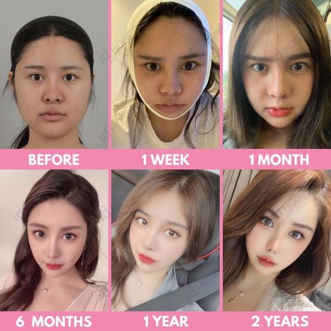 #plasticsurgery #plasticsurgerygonewrong #beforeafter #celebritiesbeforeafter #hollywoodstars #bignosesurgery #surgery #facesurgery #vlinesurgery #koreanplasticsurgery #kpopplasticsurgery #nosejob #jawreductionsurgery #eyesurgery #cheekfillers #rhinoplasty #facelift #plasticsurgeryfails #expensiveplasticsurgery Korea Rhinoplasty, South Korean Plastic Surgery, Lip Plastic Surgery, Cheekbone Reduction, Korean Surgery, Kpop Plastic Surgery, Jaw Reduction Surgery, Model Makeup Tutorial, Extreme Plastic Surgery