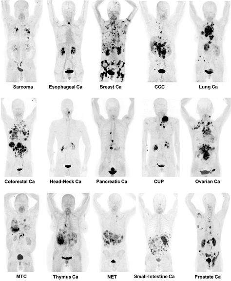 A novel class of radiopharmaceuticals has proven effective in non-invasively identifying nearly 30 types of malignant tumors, according to research published in the June issue of The Journal of Nuclear Medicine. Using 68Ga-FAPI positron emission tomography/computed tomography (PET/CT), researchers were able to image a wide variety of tumors with very high uptake and image contrast, paving the way for new applications in tumor characterization, staging and therapy. Medical Radiography, Radiology Student, Computed Tomography, Medical Pins, Pet Ct, Interventional Radiology, Basic Anatomy And Physiology, Nuclear Medicine, Medical Student Study