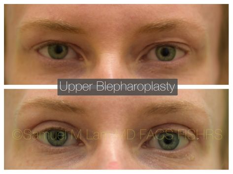 Plastic Surgery Double Eyelid, Upper Blephoraplasty, Upper Eyelid Lift Surgery, Upper Blephoraplasty Before And After, Blephoraplasty Before And After, Eye Lift Surgery, Face Plastic Surgery, Aesthetic Procedures, Attractive Face