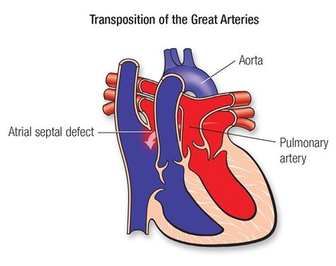 Tetralogy Of Fallot, Heart Catheterization, Atrial Septal Defect, Types Of Surgery, Congenital Heart Defect, Heart Defect, Congenital Heart, Heart Rhythms, Heart Function