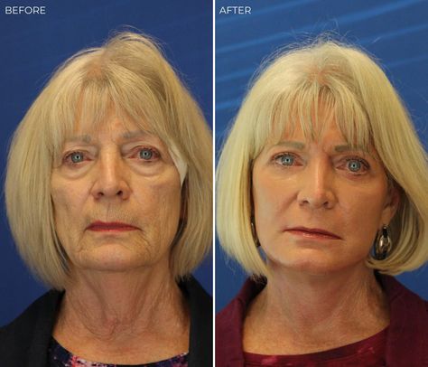 Skin Resurfacing Before And After, Laser Resurfacing Before And After, Profractional Laser Before And After, Erbium Laser Resurfacing, Ultherapy Before And After Jowls, Erbium Laser, Laser Peel, Laser Skin Rejuvenation, Face Laser