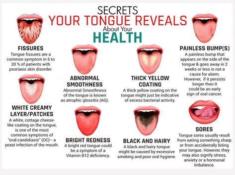 Le Mal A Dit, Hygiene Tips, Coconut Health Benefits, Stomach Ulcers, Tongue Health, Instant Messaging, Dental Hygiene, Healthy Teeth, Oral Hygiene