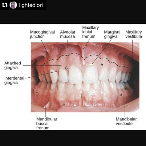 Periodontology on Instagram: “#Repost @lightedlori with @repostapp #gingiva #mucosa #periobasics #periodontology” Dental Assistant Study Guide, Dental Assistant School, Dental Hygienist School, Dental Assistant Study, Dental Hygiene Student, Dental World, Kedokteran Gigi, Dental Hygiene School, Dentistry Student