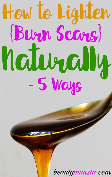 If you’re wondering how to lighten burn scars naturally, you’re in the right place! Here are 5 effective natural remedies that help! Most of us have suffered first or second degree burns at some point in our lives. You can get burned while using a curling iron or heating something on the stove. Burns can … Curling Iron Burn, Using A Curling Iron, Burn Remedy, Natural Beauty Hacks, Burn Care, Scar Remedies, Degree Burns, Skin Burns, Skin Natural Remedies