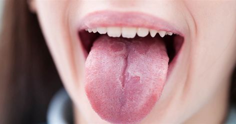 From a dry, sticky coating to small round lesions, discolored taste buds to pockets of pus, there are many reasons why the tongue can appear white. The fade from pinkish-red can occur overnight or develop slowly over time. Sometimes there's soreness, but not always. Lichen Planus, White Tongue, Signs Of Inflammation, Mouth Rinse, Chronic Obstructive Pulmonary Disease, Vitamin Deficiency, Lactobacillus Acidophilus, Pulmonary Disease, Nutritional Deficiencies