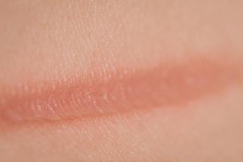 How to Get Rid of Burn Marks on the Skin with Home Remedies. At least once in our lives, we've bumped into a hot skillet or been surprised by some drops of boiling oil on our skin. Burn... How To Treat Burns Skin, Burned Skin Remedies, Burns On Skin, Drawing References Anatomy, Volumetrics Diet, Ornish Diet, Side Bends, How To Heal Burns, Chemical Burn