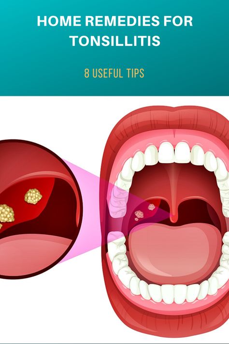 Remedies For Swollen Tonsils, Swollen Tonsils, Human Mouth, Loose Tooth, Cold Symptoms, Lose Pounds, Homeopathy, Health Advice, Herbal Remedies