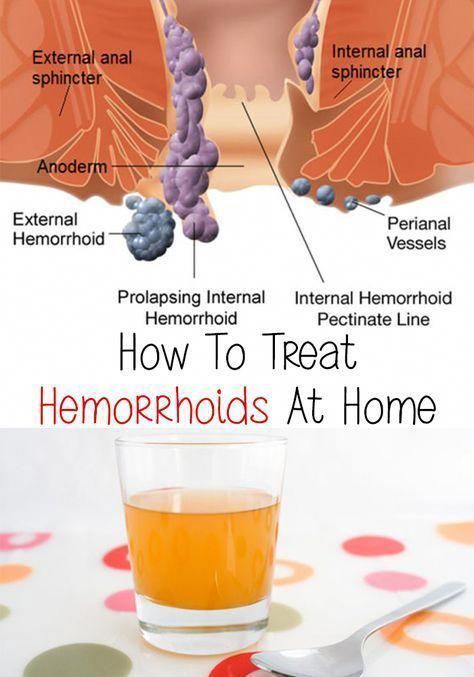 What Causes Piles, Piles Remedies, Hemorrhoid Remedies, Heal Thyself, Homemade Remedies, Alternative Health, Homeopathy, Natural Treatments, Herbal Medicine