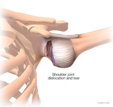 Shoulder Physical Therapy, Shoulder Instability, Shoulder Anatomy, Shoulder Dislocation, Rotator Cuff Tear, Running Program, Parent Coaching, Rotator Cuff, Muscle Fatigue