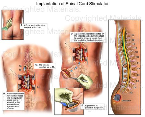 Implantation of Spinal Cord Stimulator : Medical Exhibit Spinal Cord Stimulator Implant, Human Body Lesson, Spinal Degeneration, Spinal Cord Stimulator, Spinal Fusion Surgery, Spinal Fusion, Chronic Pain Management, Spinal Surgery, Shoulder Pain Relief