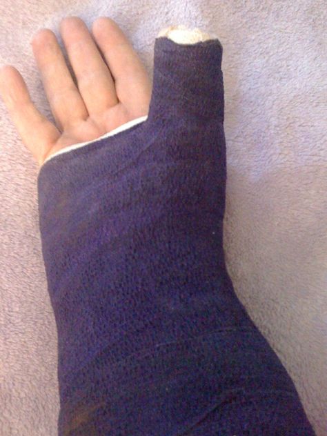 Fractured right wrist. Alien House, Arm Cast, Fingerless Gloves, Arm Warmers, Bts, Quick Saves, Pins, Art