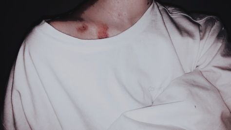 Hickies Neck, Ruki Mukami, Kiss Mark, Isak & Even, Love Bites, L Lawliet, Fan Fiction, William Shakespeare, Chanyeol