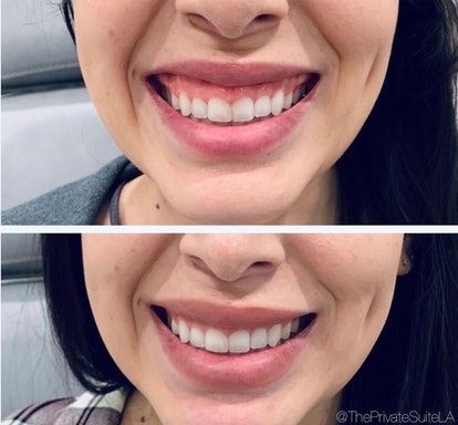 Lip Botox Before And After, Lip Augmentation Before And After, Lip Injections Before And After, Cheekbone Filler Before And After, Lip Injections Small Lips, Lip Flip Botox Before And After, Full Lips Injections, Small Mouth With Lip Injections, Lip Filler Before And After