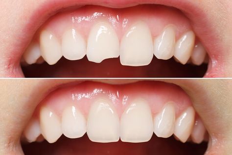 Teeth Bonding, Cracked Tooth, Chipped Tooth, Dental Bonding, Tooth Repair, Nice Teeth, Dental Veneers, Tooth Extraction, Dental Procedures