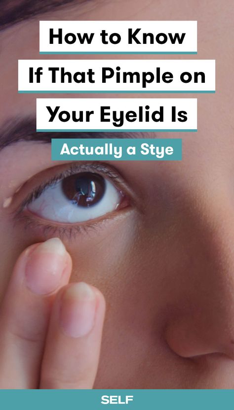 People typically use the word “stye” to refer to what ophthalmologists know as either a chalazion or a hordeolum. These eyelid bumps are similar to pimples, but with one major difference. While pimples can happen around your eyes, if you’re dealing with a bump directly on the eyelid (especially on your lash line anywhere) or right underneath it, acne probably isn’t your issue. Here's what you need to know about the symptoms and treatments for styes. #stye #eyehealth #pimples Stye Remedy, Eye Stye Remedies, Pimples On Buttocks, Varicose Vein Removal, Blind Pimple, Pimples Under The Skin, Droopy Eyelids, Acne Remedies, Moisturizing Body Wash