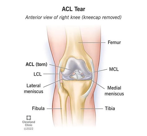 The ACL is the most commonly injured knee ligament. Sports injuries usually cause ACL tears. If you tear your ACL, you’ll probably need surgery to repair it. Most people who tear their ACL make a full recovery and resume playing sports with no long-term consequences. The recovery time for a torn ACL is usually six to nine months. Acl Tear Symptoms, Acl Knee, Acl Rehab, Acl Injury, Torn Acl, Knee Ligaments, Medical Illustrations, Acl Surgery, Anterior Cruciate Ligament