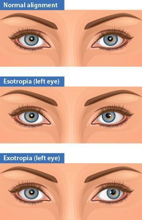 Strabismus Surgery, Crossed Eyes, Dry Eyes Causes, Swollen Eyes, Two Eyes, Eye Damage, Vision Therapy, Irritated Eye, Ghost Images