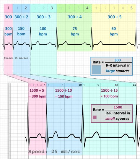 ECG Rate Interpretation • LITFL Medical Blog • ECG Library Basics Ekg Interpretation, Ecg Interpretation, Medical Assistant Student, Paramedic School, Nursing Classes, Med Surg Nursing, Nursing Assessment, Nursing School Essential, Nursing Courses