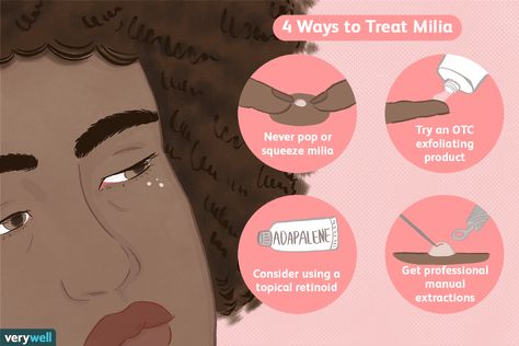 The Best Ways to Treat Milia White Bumps On Skin, Bumps On Skin, The Ordinary Glycolic Acid, Skin Advice, Retinol Eye Cream, Take Care Of Your Skin, Sweat Gland, Eye Serum, Glycolic Acid