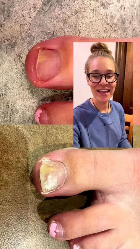 How to treat fungal nail infection Toenail Problems, Toenail Health, Nail Remedies, Nail Fungus Remedy, Fungal Nail, Diy Skin Care Recipes, Ingrown Toe Nail, Toenail Fungus, Healthy Skin Tips