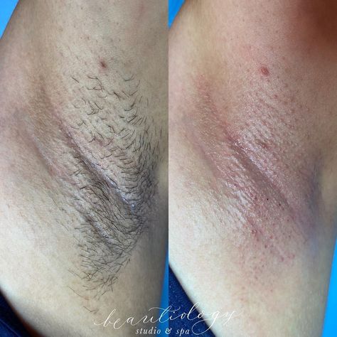 LI Makeup Studio & Spa on Instagram: “If this is your first time waxing your armpits, be prepared for results like this. This client was waxing every 2-3 weeks on a strict…” Makeup Studio, Be Prepared, 3 Weeks, Home Remedies, First Time, Wax, Spa, Health, Makeup