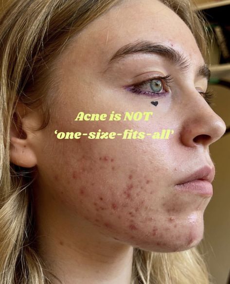 Acne Positivity, Skin Positivity, Causes Of Acne, Taking Care Of Myself, Face Mapping Acne, Body Positive Quotes, Acne Vulgaris, Face Mapping, Unsolicited Advice