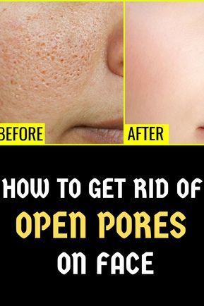 Want to know about HOW TO GET RID OF OPEN PORES ON FACE? We have listed natural home remedies for close open pores. #openpores #skincare #homeremedies Open Pores On Face, Pores On Face, Skin Care Procedures, Lotion For Oily Skin, Face Pores, Open Pores, Spots On Face, Moisturizer For Oily Skin, Large Pores