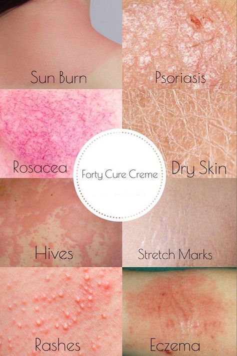 The 10 Essential & Plant Oils That Can Treat Eczema Dry Skin Causes, Skin Anatomy, Beauty Skin Quotes, Skin Facts, Skin Aesthetics, Types Of Skin, Skin Disorders, Skin Remedies, Skin Diseases