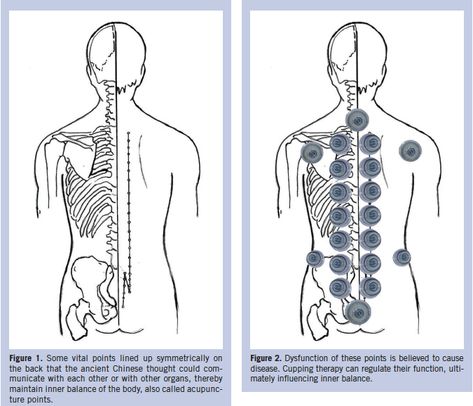 Cupping Therapy Chinese Cupping Points, Cupping Therapy Placement Chart, Cupping Therapy Advertisement, Cupping Placement Chart, Dry Cupping Therapy, Suction Cup Therapy, Cupping Points, Chinese Cupping, Traditional Chinese Medicine Acupuncture