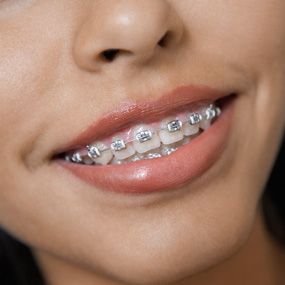 Overbite Braces, Invisible Teeth Braces, Cute Braces Colors, Braces Tips, Getting Braces, Traditional Braces, Braces Girls, Cute Braces, Brace Face