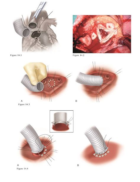 Suture Techniques, Thoracic Surgery, Emt Study, Aortic Valve Replacement, Nurse Notes, Heart Valve, Heart Valves, Heart Pump, Coronary Arteries