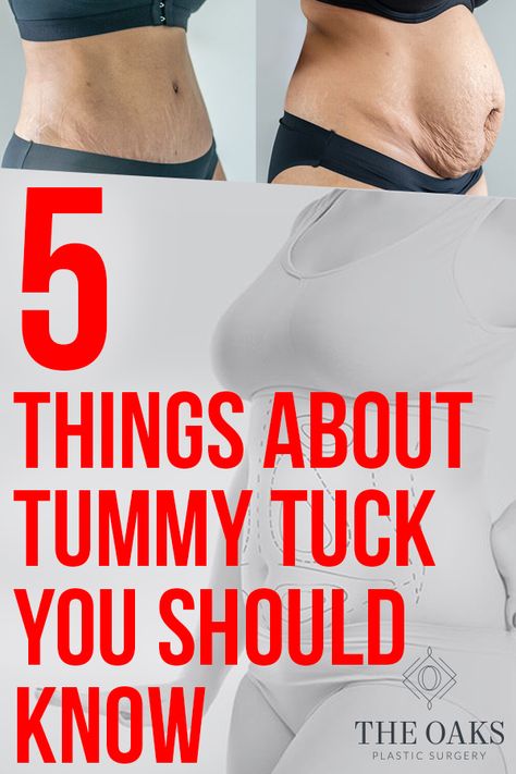 5 THINGS YOU SHOULD KNOW ABOUT TUMMY TUCK  #plasticsurgery #surgery #tummytuck #wishpic #wishpics #body #cosmetics #cosmeticsurgery #breastimplants #breastaugmentation #boobjob #mommymakeover #momlife #makeover #transformation #mommy #houston #faq #5things Abdominalplasty Before And After, Tummy Tucks 360, Yummy Tuck Before And After, Tummy Tucks Recovery Timeline, Mommy Makeover Must Haves, Mommy Makeover Before And After, Tummy Tucks Recovery List, Tummy Tucks Recovery Tips, Mommy Makeover Surgery Before And After Tummy Tucks