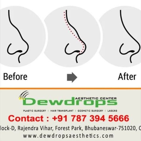 #Rhinoplasty reshapes your nose to improve your appearance or to fix medical problems that interfere with how you breathe. It can correct a deviated septum or a broken nose. #plasticsurgery #nosesurgery #bestdoctors #Bhubaneswar Improve Your Appearance, Broken Nose, Aesthetic Center, Nose Surgery, Best Doctors, Medical Problems, Hair Transplant, Cosmetic Surgery, Plastic Surgery