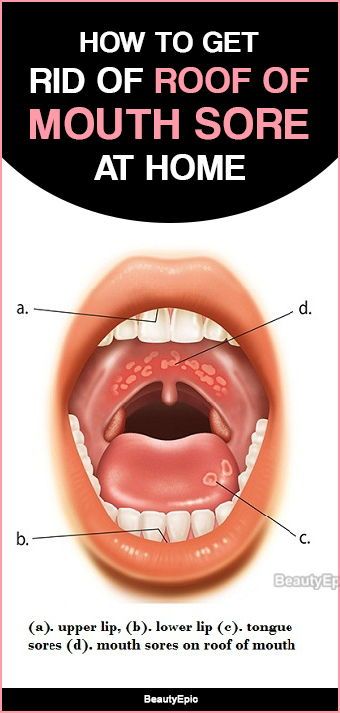 How to Get Rid of Roof of Mouth Sore Roof Of Mouth Sore, Mouth Blisters, Mouth Sore, Tongue Sores, Lung Health, Canker Sore, Tongue Health, Helpful Things, Best Teeth Whitening