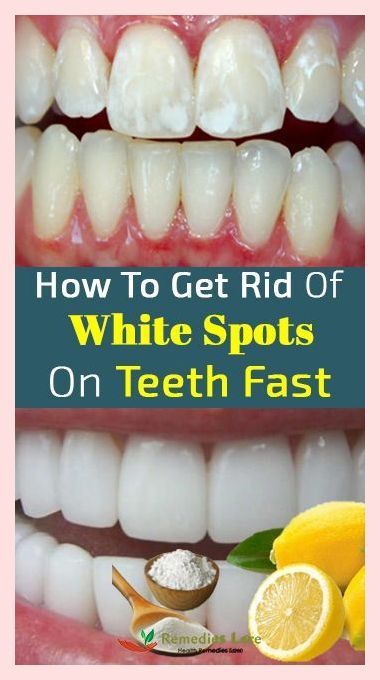 Much appreciation. Astonishing information and facts. White Spots On Teeth, Sensitive Teeth Remedy, Healthy Mouth, Women Health Tips, Receding Gums, Oral Care Routine, Gum Care, Natural Teeth Whitening, Fitness Style