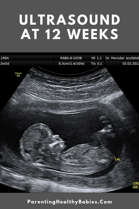 #week12ultrasound #ultrasoundat12weeks #ultrasound Ultrasound By Week, Baby Boy Ultrasound Pictures, 20 Week Ultrasound Pictures, 13 Weeks Pregnant Ultrasound, 11 Weeks Pregnant Ultrasound, 12 Week Ultrasound Pictures, 10 Week Ultrasound Pictures, 12 Week Ultrasound Gender, 10 Weeks Pregnant Ultrasound