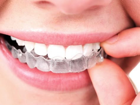 Flossing contributes to good dental hygiene because it lifts and removes plaque and food in between your teeth. This article provides tips on how to get the most out of flossing and brushing. Clear Retainers, Ceramic Braces, Fix Teeth, Braces Cost, Invisalign Aligners, Invisalign Braces, Teeth Alignment, Invisible Braces, Clear Braces