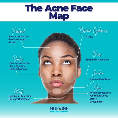 On a Monday, and you got an ACNE? 🙅 🙅 Here's a guide in understanding better why are you getting it and where these tiny tiny acnes are lingering. 😎 💥 Jawline Pimple breakouts in your jawline are a variant indicator that your reproductive health and hormones are out of whack. 💥Chin Area You might need to check your gut, or perhaps you need to improve your detoxification. Check your carb intake 👌 💥 Between the Eyebrows Lack of sleep and stress is your culprit! 💥 Forehead Hmm, consider re- Pimple Location Meaning, Chin Acne Causes, Jawline Acne, Head Acne, Face Mapping Acne, Forehead Acne, Face Mapping, Acne Causes, Perfect Skin Care Routine