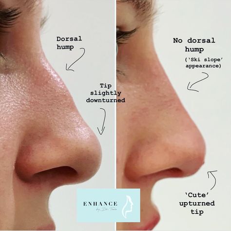 Nose enhancement to camouflage the dorsal hump 👃🏽 Ski Slope Nose, Slope Nose, Hump Nose, Nose Filler, Nose Plastic Surgery, Nonsurgical Nose Job, Nose Surgery Rhinoplasty, Nose Fillers, Drawing Nose